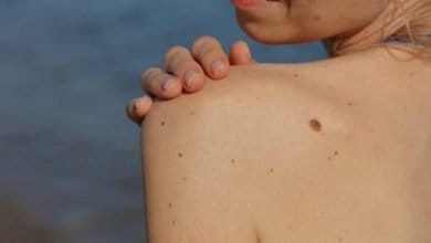 Señales para detectar lunares peligrosos