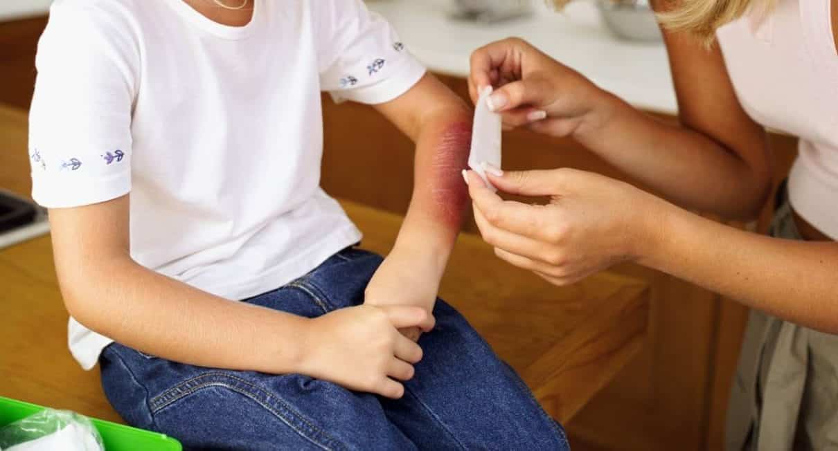 Cómo evitar quemaduras y otros accidentes en casa: MinSalud