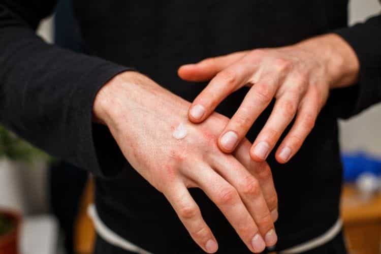 Las 5 alergias más raras y poco frecuentes